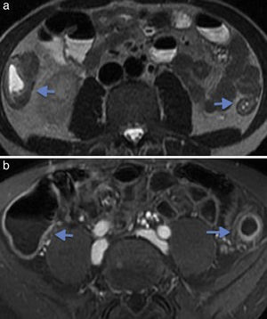 Paciente de 39 años con colitis ulcerosa. (a y b) Imágenes axiales de enterografía por resonancia magnética que exhiben engrosamiento de las paredes del colon con realce temprano de la mucosa colónica por compromiso inflamatorio agudo (flechas).