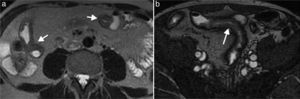 Enfermedad de Crohn en paciente de 47 años. (a y b) Imágenes axial y coronal de la enterografía por resonancia magnética en secuencias eco de espín ponderadas en T2 que presentan engrosamiento transmural, irregular y discontinuo de las paredes del íleon (flechas).