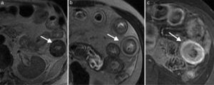 Enfermedad de Crohn en fase aguda en paciente de 42 años. Imagen axial de la enterografía por resonancia magnética en secuencias eco de espín ponderadas en T2 en la que se observa (a) engrosamiento de la pared, (b) edema mural y (c) realce con la administración de medio de contraste (flechas).