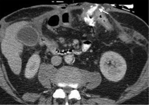 Paciente con enfermedad de Crohn en fase penetrante con cambios posquirúrgicos por resección de las asas intestinales delgadas. Imagen axial de tomografía de abdomen que revela extraluminización del medio de contraste hacia la pared intestinal por formación de fístula (flecha).