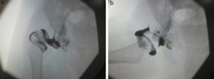Paciente de 11 meses de edad con enfermedad luxante de cadera derecha. (a) La artrografía intraoperatoria muestra una luxación de la cabeza del fémur. (b) Imagen de la artrografía intraoperatoria después de la reducción.