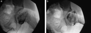 Paciente de 8 años con enfermedad de Perthes. (a) La visión radioscópica intraoperatoria (a) de frente y (b) perfil objetiva una deformidad de la cabeza femoral con ausencia de la cadera en bisagra (bloqueo).