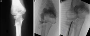 Paciente de 4 años de edad con dolor y limitación de la pronosupinación luego de una caída desde su propia altura con el brazo en extensión. (a) La radiografía del codo de frente muestra una fractura del cuello de radio a nivel metafisario, donde la cabeza del radio no se encuentra osificada, por lo que es difícil determinar la angulación/traslación a nivel de la fractura. (b) La artrografía intraoperatoria evidencia una angulación de 35˚ y una traslación>2mm. (c) Se observa la reducción y fijación con el método de Metaizaeau.