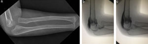 Paciente de 4 años de edad con dolor y limitación de la movilidad de codo. (a) La radiografía del antebrazo de perfil revela una fractura diafisaria del cúbito y la luxación anterior de la cabeza del radio (fractura de Monteggia tipo Bado I). (b) La artrografía intraoperatoria identifica la luxación de la cabeza del radio. (c) La artrografía intraoperatoria luego de la reducción.