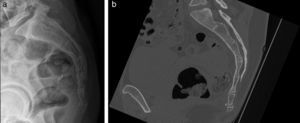 (a) La radiografía lateral sacro-coxígea revela una calcificación oval precoxígea a nivel del primer segmento coxígeo, (b) confirmada en la tomografía computada en reconstrucción sagital.