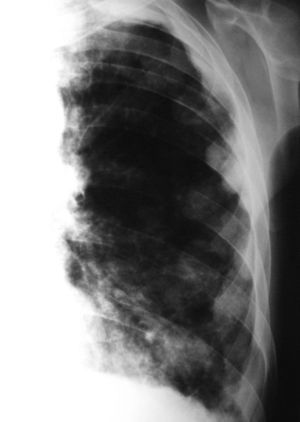 Radiografía de tórax posteroanterior con engrosamiento pleural multilobulado izquierdo, rodeando todo el pulmón.