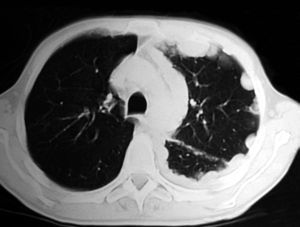 Tomografía computada con engrosamiento pleural unilateral izquierdo, de aspecto lobulado, que rodea completamente al pulmón, con engrosamiento nodulillar de la cisura izquierda.