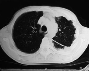 Tomografía computada de tórax con engrosamiento pleural multilobulado y masas pleurales que se proyectan sobre el pulmón izquierdo, pérdida de volumen del hemitórax ipsilateral y extensión del tumor hacia la cisura izquierda.