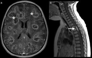 Imágenes ponderadas en T1 con gadolinio a los dos meses de evolución: a nivel del cerebro (a) evidencian lesiones en la sustancia blanca con refuerzo anular (asteriscos) y a nivel de la médula espinal (b) muestran una lesión con realce pseudonodular en niveles D3 y D4 (flecha blanca).