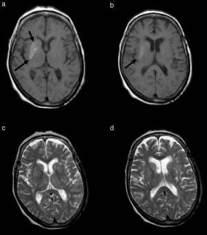 La resonancia magnética revela (a y b) hiperintensidad de señal en las secuencias ponderadas en T1 en el núcleo lenticular derecho y una hiperintensidad más leve en la cabeza del núcleo caudado (flechas), mientras que (c y d) en las secuencias ponderadas en T2 la afectación del núcleo caudado es más evidente y se identifica con zonas de hiperintensidad de señal.