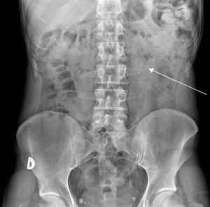 Radiografía de abdomen 2 días antes de la consulta: se observa una imagen nodular radiodensa, sugestiva de litiasis en el tercio superior del uréter izquierdo (flecha).
