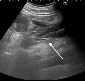 Ecografía: en el riñón izquierdo se evidencia una gran colección de líquido anecoico en el espacio perirrenal y litiasis obstructiva en el tercio proximal del uréter (flecha).