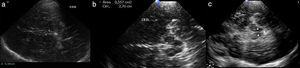 Ultrasonografía de un paciente esquizofrénico muestra (a) un tercer ventrículo normal (menor de 5mm: A-A), (b) un área de sección a nivel de la sustancia negra de 0,55 cm2 (líneas de puntos) y (c) una sustancia negra y un rafe hiperecogénicos (cabezas de flecha).