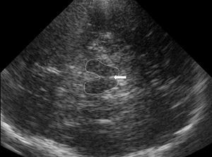 Ultrasonografía en plano axial identifica el mesencéfalo (línea punteada) con hiperecogenicidad del rafe medio (flecha).