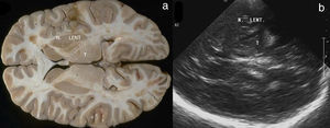 Corte axial encefálico de material cadavérico humano (a) y sección oblicua ultrasonográfica (b) al mismo nivel. Se señalan el núcleo lenticular (N. LENT) y el tálamo (T), con hiperecogenicidad correspondiente a alteración del sistema dopaminérgico (b) en un paciente con marcada rigidez.