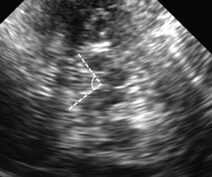 Ultrasonografía en plano axial con corte del mesencéfalo evidencia un aumento del ángulo interpeduncular.