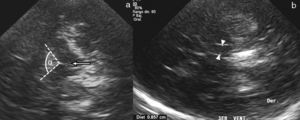Ultrasonografía de un paciente con parálisis supranuclear progresiva revela (a) un aumento del ángulo interpeduncular (α) y un rafe hiperecogénico (flecha), y (b) un aumento del diámetro transverso del tercer ventrículo (cabezas de flecha), que supera los 5mm.