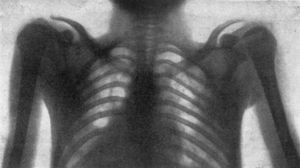 Primera radiografía de tórax, 1896 (cortesía del Siemens Med Museum).