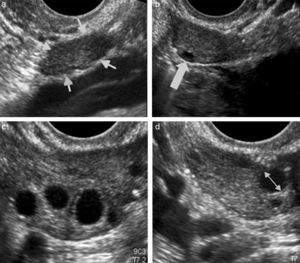 Ecografías transvaginales para recuento de folículos antrales: (a) ovario (flechas) sin ningún folículo antral; (b) ovario con un solo folículo antral (flecha); (c) imágenes anecogénicas redondeadas que representan folículos antrales; y (d) medición el diámetro interno del folículo (flecha).