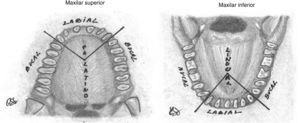 Ilustración del emplazamiento del diente SN en función de su ubicación anterior o posterior. Se define en cara lingual si el SN se sitúa anterior a un incisivo o canino en el maxilar superior o inferior y en cara bucal si es anterior a cualquier otro diente. En caso de ser posterior, se define en cara palatina en el maxilar superior y en cara lingual en el maxilar inferior.