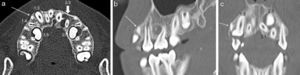 Tomografía computada maxilar con ventana de hueso en (a) plano axial y reconstrucciones multiplanares en plano (b) sagital y (c) coronal. Se objetiva un diente SN interdentario, entre 1.3 y 1.4 (flechas finas), rudimentario cónico, de orientación vertical y sin angulación. Los dientes 1.5 y 2.5 están incluidos en el maxilar con quistes foliculares asociados, mientras que el 2.1 se observa horizontalizado con la corona en dirección distal, generando (c) la inclusión del 2.3, que se relaciona con un quiste folicular. Persiste el diente temporal 5.3 (flecha gruesa).
