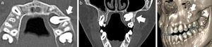 Tomografía computada maxilar con ventana de hueso en (a) plano axial y reconstrucciones (b) coronal y (c) 3D VR. Se muestra un diente SN (flechas) craneal a los dientes 2.4, 2.5 y 2.6, de orientación horizontal con la corona mesial, de morfología suplementaria y ligeramente angulado caudalmente. Su raíz interrumpe la cortical bucal del maxilar (flechas en a y c) y se observa (a y b) un quiste folicular rodeando la corona.