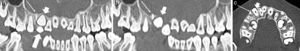 Tomografía computada maxilar, con ventana de hueso (a y b) con reconstrucciones panorámicas y (c) en plano axial, muestra un diente SN muy rudimentario (flechas finas) distal y craneal al diente incluido 1.3 (flechas cortas). Persiste el diente temporal 5.3 (flecha grande en a).
