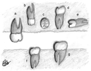 Ilustración de los tipos de orientación de un SN: (a) vertical erupcionado, (b) vertical no erupcionado o incluido, (c) transversa, (d) vertical invertida y (e) horizontal. También se muestra si un diente SN está erupcionado (f) parcialmente o (g) totalmente.