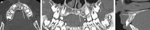 Tomografía computada maxilar con ventana de hueso en (a) plano axial y reconstrucción (b) panorámica y (c) en plano sagital. Se muestra un diente SN (flechas) peridentario, craneal y palatino al diente 2.2, de (b) orientación transversa y (c) leve angulación craneal de la corona, que impacta parcialmente en la cortical posterior del maxilar.