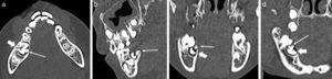 Tomografía computada maxilar con ventana de hueso en (a) plano axial y reconstrucciones en plano (b) sagital, (c) coronal y (d) panorámico. Se observa un diente SN (flechas finas) parapremolar, craneal y mesial al diente 8.5, muy rudimentario. La pieza 8.5 (flechas gruesas) está horizontalizada y anquilosada, con la raíz en contacto con la cara bucal del maxilar y la corona angulada posteriormente.