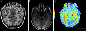 Paciente de sexo femenino de 4 años de edad muestra (a y b) en ponderación T1 y en tridimensional con secuencia rápida de eco gradiente dañado, en corte coronal y axial, un engrosamiento cortical focal con pérdida de diferenciación de la sustancia gris-blanca a nivel occipital basal izquierdo (flechas). (c) En el mapa de color de fracción de anisotropía se identifica una leve disminución de la misma a nivel de la sustancia blanca occipital izquierda (flechas) con respecto a la región homóloga contralateral.