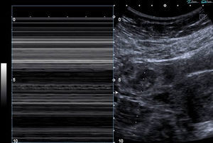 Anillo tubario tipo I con embrión en su interior que presenta actividad cardíaca positiva, demostrada en modo M.