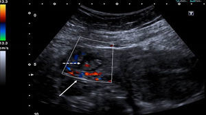 Anillo tubario que presenta una corona hipervascular (flecha continua) demostrada mediante evaluación Doppler color. El embrión tiene actividad cardíaca positiva (flecha discontinua).