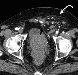 Tomografía computada multidetector en plano axial revela una hernia inguinal indirecta (flecha curva) con contenido de grasa y asas de intestino delgado. Se observan los vasos epigástricos (flecha negra) y el cuello herniario (flechas blancas rectas).
