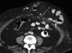 Tomografía computada multidetector en plano axial de una hernia umbilical (flecha curva) con contenido de grasa y asas de intestino delgado (flecha recta).