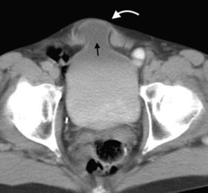 Tomografía computada multidetector en plano axial identifica una hernia incisional de corte transversal (flecha curva) en la que se observa una eventración del techo vesical (flecha recta).