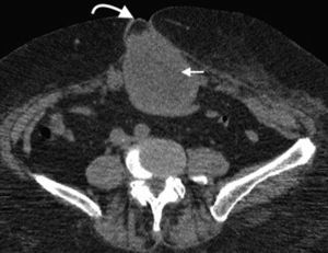Tomografía computada multidetector en plano axial de una hernia umbilical (flecha curva) que presenta un implante sólido (flecha recta), secundario a un tumor de ovario (nódulo de la hermana María José).