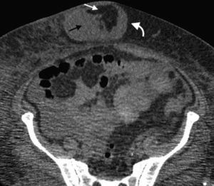 Tomografía computada multidetector en plano axial del abdomen visualiza una hernia umbilical (flecha curva) con contenido de grasa peritoneal (flecha recta blanca) y ascitis (flecha recta negra).