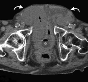 Tomografía computada multidetector en plano axial de una voluminosa hernia inguinal bilateral (flechas curvas) con contenido de asas de intestino delgado distendidas (flecha recta).