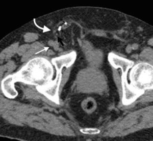 Tomografía computada multidetector en plano axial muestra una hernia inguinal directa (flecha curva), medial a los vasos femorales (flecha recta), con asas intestinales en su interior. Se señalan los vasos epigástricos (flecha negra).