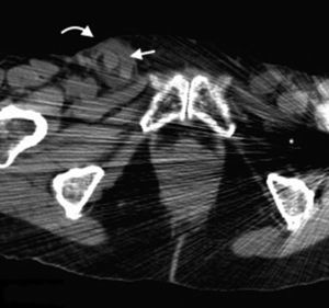 Tomografía computada multidetector en plano axial identifica una pequeña hernia inguinal derecha (flecha curva) con apéndice cecal en su interior (flecha recta), corroborado en la cirugía (hernia de Amyand).