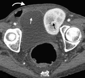 Tomografía computada multidetector en plano axial muestra una hernia incisional transversal (flecha curva), que presenta en su interior un riñón trasplantado (flecha recta negra) y el techo vesical (flecha recta blanca).