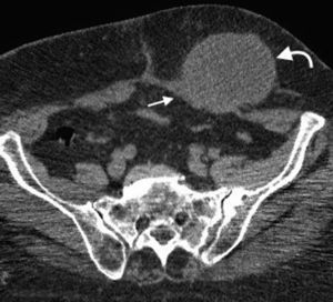 Tomografía computada multidetector en plano axial de hernia de Spiegel de un implante secundario en la pared abdominal (flecha curva). Se muestra como referencia el músculo recto anterior del abdomen (flecha recta).