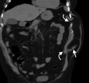 Tomografía computada multidetector en plano coronal de una hernia intercostal izquierda con contenido graso y asas de intestino delgado (flecha recta), que muestra los espacios intercostales intervinientes (flechas curvas).