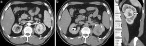 (a, b y c) Hombre de 63 años de edad con carcinoma de células renales de 5,3cm en el riñón izquierdo (flechas). El sufijo x es utilizado por la localización central de la lesión y, además, se agrega el sufijo h por su localización hiliar, al presentar contacto con los vasos renales principales, en este caso con la arteria renal (cabeza de flecha). RS: 2+3+3+x+3=11xh (alta complejidad quirúrgica).