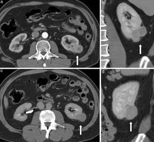 TCMC en planos (a) axial, (b) coronal, (c) axial en fase excretora y (d) sagital, de un hombre de 57 años de edad con carcinomas de células claras de 4,4cm en el riñón izquierdo (flechas). RS: 2+1+1+p+2=6p (baja complejidad quirúrgica).