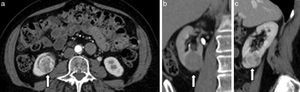 TCMC en planos (a) axial, (b) coronal en fase excretora y (c) sagital, de una mujer de 60 años de edad con carcinoma de células claras de 3,2cm en el riñón derecho (flechas). RS: 1+3+2+x+1=7p (mediana complejidad quirúrgica).