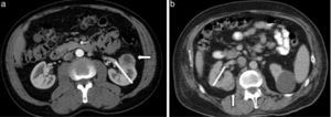 (a) Hombre de 61 años de edad con carcinoma de células claras de 3,5cm (flecha) localizado por delante de la línea media renal (línea blanca) del riñón izquierdo. RS: 1+2+3+a+3=9a (mediana complejidad quirúrgica). (b) Hombre de 73 años de edad con carcinoma de células claras de 3,4cm (flecha) localizado por detrás de la línea media renal (línea blanca) del riñón derecho. RS: 1+2+2+p+2=7p (mediana complejidad quirúrgica).