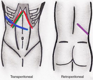 Vías de abordaje quirúrgico de nefrectomía abierta. Línea verde: subcostal anterior. Línea roja: subcostal anterior bilateral o incisión de Chevron. Línea azul: tóraco-abdominal. Línea morada: flanco.