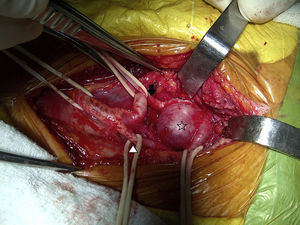 En la exploración quirúrgica se identifica el aneurisma sacular (asterisco) de la arteria carótida interna (flecha) y de la externa desplazada (cabeza de flecha).